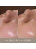根本から整える肌質改善プログラム ピーリング×マシン♪通常¥22,000→¥13200