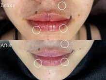 ルミナ シブヤ(LUMINA SHIBUYA)/シミケア