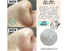 リッカロッカ(RIKKA&ROCCA)/毛穴エクストラクション