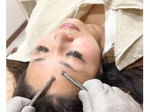 ナル ゆあん鍼灸接骨院(nalu)/マイクロカレント美容鍼