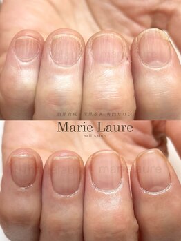 マリーロール 梅田店(Marie Laure)/深爪矯正/自爪育成/自爪風