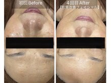 ケイ(Kei)の雰囲気（お肌をキレイにしたいならコレ！肌質改善フェイシャル☆）