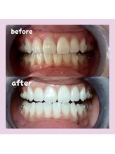 パレ 大阪十三店(Palet)/before/after