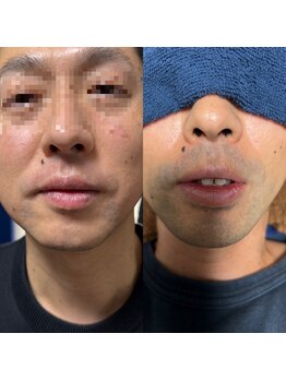 シェービーズ(shavys)/青ヒゲ対策