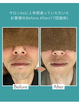 アオ(Ao)/ヒゲ脱毛17回施術後