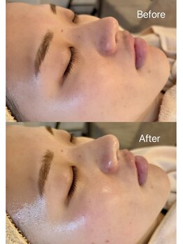 イーズ(eees)/ウルツヤ毛穴ケアの施術後