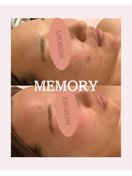 メモリー(MEMORY)/肌質改善☆