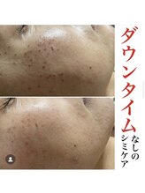 エアリアル 大牟田店/シミケア【ビフォーアフター】