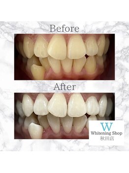 ホワイトニングショップ 秋田店/【before after】 美白