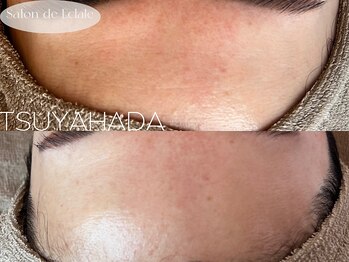 サロンドエクラル(Salon de Eclale wax)/大人の肌育＊つるりんおでこ