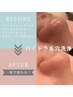 2回コース《いちご鼻*黒ずみ撃退》韓国式ハイドラ毛穴洗浄 (鼻・頬)¥11,000→