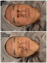 シャンス(Chance)/ピーチリフト　症例1回目