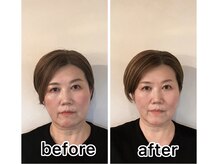 ドクターコガオ 福山店(Dr.小顔)/★私自身の変化★