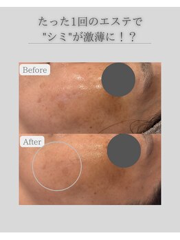 ラヴニール(L'avenir)/1回のエステケアでシミが改善