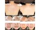 ハルミハーブピーリング 新宿店(Harumi Herb Peeling)の写真