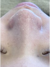 セラピー(therapy)/韓国式3D毛穴洗浄