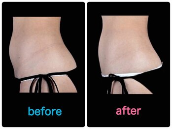 エルミューノ(elμno)/腹部 ビフォーアフター