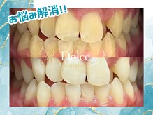 ドルチェ(Dolce)/ビフォーアフター