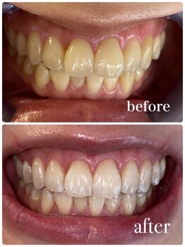 ビューティーケア(beauty care)/ホワイトニング×ホワイトニング