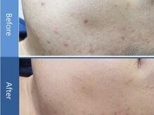 ヴィヴァンビー(Vivant+B)/before/after