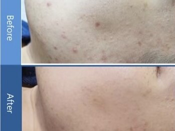 ヴィヴァンビー(Vivant+B)/before/after