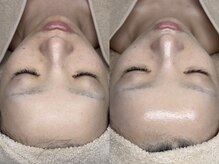 キヌ(KINU)/症例写真（肌質改善）