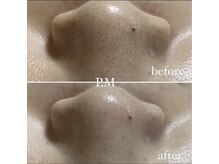 ピーエム(P.M)/いちご鼻毛穴洗浄