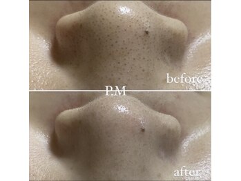 ピーエム(P.M)/いちご鼻毛穴洗浄