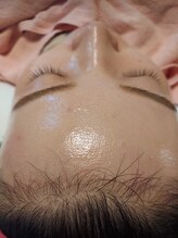 キアラ 麻布十番(Kiara)/顔脱毛