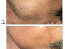 レジュ(RE:JU)の雰囲気（ひげ脱毛¥4000★青髭やカミソリ負け卒業♪清潔感UP！）