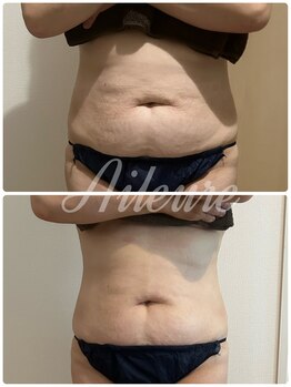 エルール トータルビューティ(Aileure total beauty)/インディバ痩身