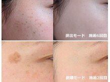 ナチュレアンドメディカ(Nature&Medica)/シミ集中ケア(Wフェイシャル)