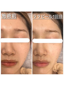 べっぷ餅ヶ浜鍼灸院/ララピールBefore/ After