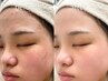 【ニキビが気になる方に】６ヶ月ニキビ徹底ケアコース　