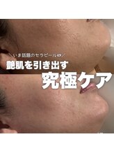 ジェノール 2nd beauty studio 姫路駅前店(JNOEL)/艶肌の究極ケア！セラピール