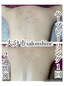 サロンシャイン(Salon Shine)/ハーブピーリングハード1回