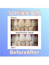 ホワイトニングショップ 西原店/50代後半女性☆BeforeAfter