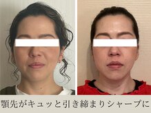 オルビナ(Orbina)/小顔矯正