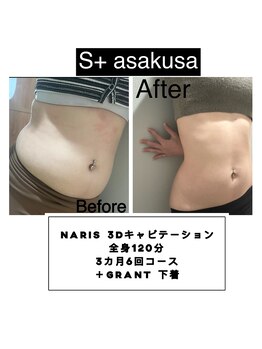 エスプラス アサクサ(S+ASAKUSA)/３Ｄキャビテーション　最高