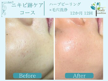 ボディコンディション/ハーブピーリング/毛穴洗浄/小顔