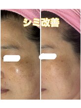 サロン ド ピュール(SALON DE PURE)/レチノールピール/シミケア/浜松