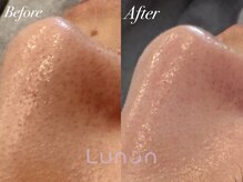 ルノン(Lunon)/毛穴洗浄ハイドロ×ララピール