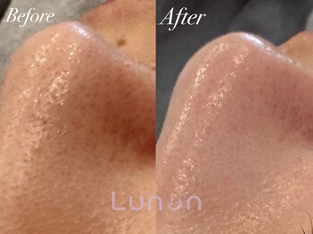 ルノン(Lunon)/毛穴洗浄ハイドロ×ララピール