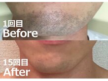 バーニー 梅田店(BARNEY)/ヒゲ脱毛の効果(15回目)/顔脱毛