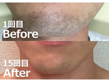 バーニー 梅田店(BARNEY)/ヒゲ脱毛の効果(15回目)/顔脱毛