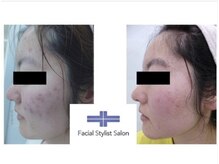 フェイシャルスタイリストサロン 四谷店/ケア例(８)