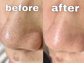 ルピエ(Lupir)/毛穴洗浄ハイドラフェイシャル！