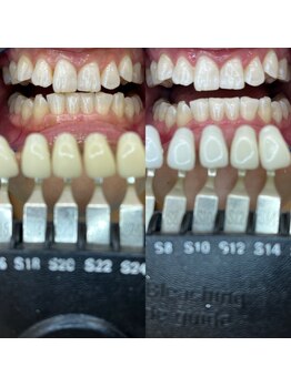 トウキョウスワーズ 池袋店(TOKYO SWRS)/#ホワイトニング #池袋 #渋谷