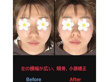 美容矯正サロン レレポノ(LELEPONO)/頬骨、左の横幅が広いのを矯正