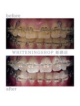 ホワイトニングショップ 姫路店/矯正中ホワイトニング